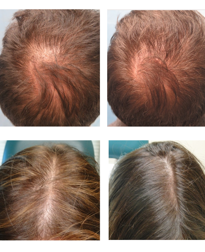 PRP hair injections - Sapiegos clinic
