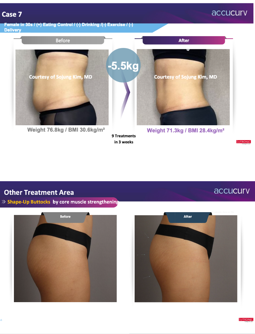 Results that can be expected after “Lutronic Accucurv” treatments