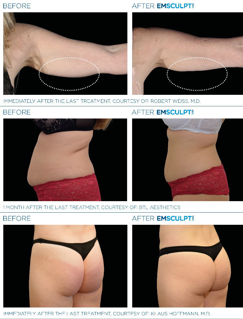 Results you can expect after EMSCULPT NEO treatments*