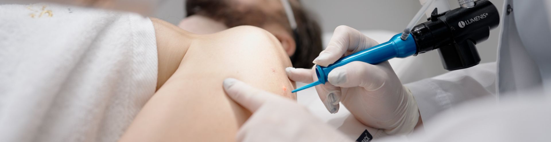 Dermatologas lazeriu šalina apgamą nuo vyro peties – apgamų šalinimo lazeriu procedūra