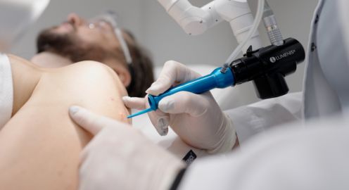 Dermatologas lazeriu šalina apgamą nuo vyro peties – apgamų šalinimo lazeriu procedūra