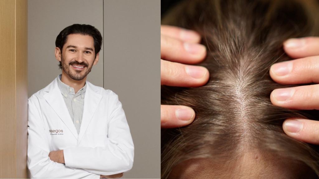 plaukų slinkimas po 30