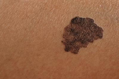 melanoma