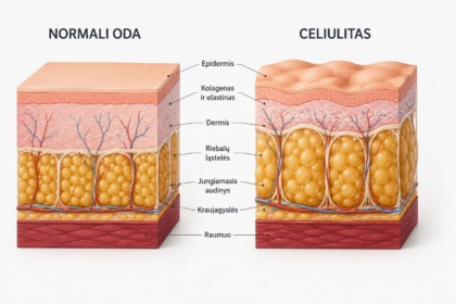 celiulitas